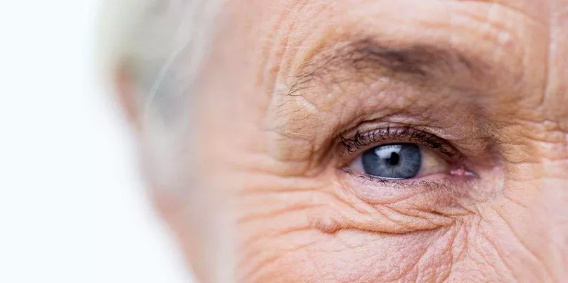 Yaşa Bağlı Makula Dejenerasyonu